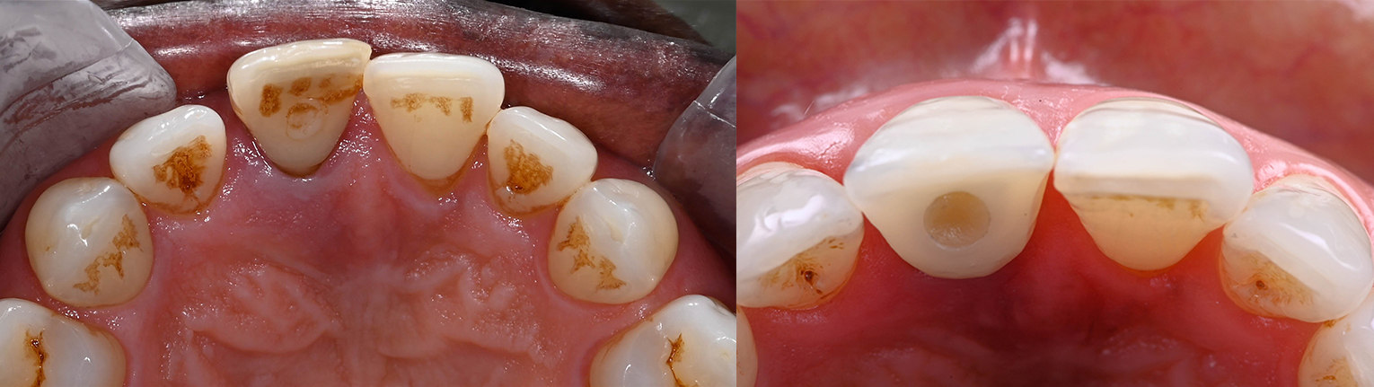 Occlusal_Abouzeid-5.jpg