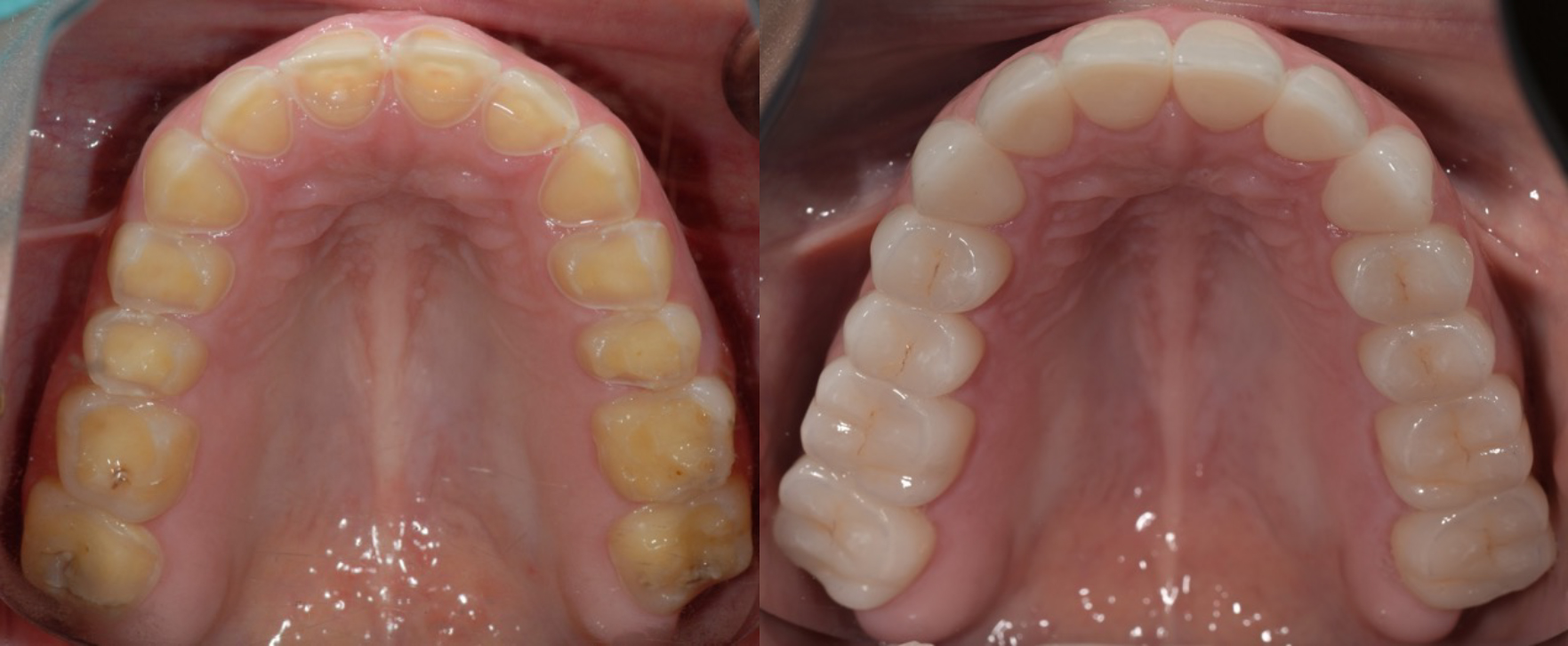 Occlusal_Gatta.jpg